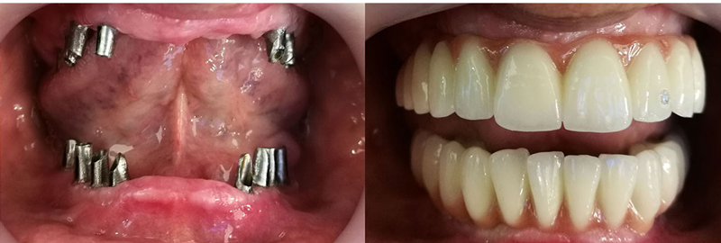 قبل و بعد از درمان ایمپلنت دندان
