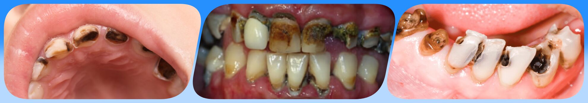 راه های جلوگیری از پوسیدگی دندان