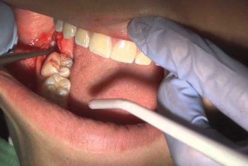 جراحی کشیدن دندان عقل نهفته