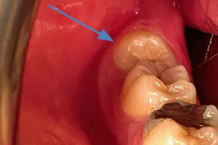 جراحی دندان عقل نهفته