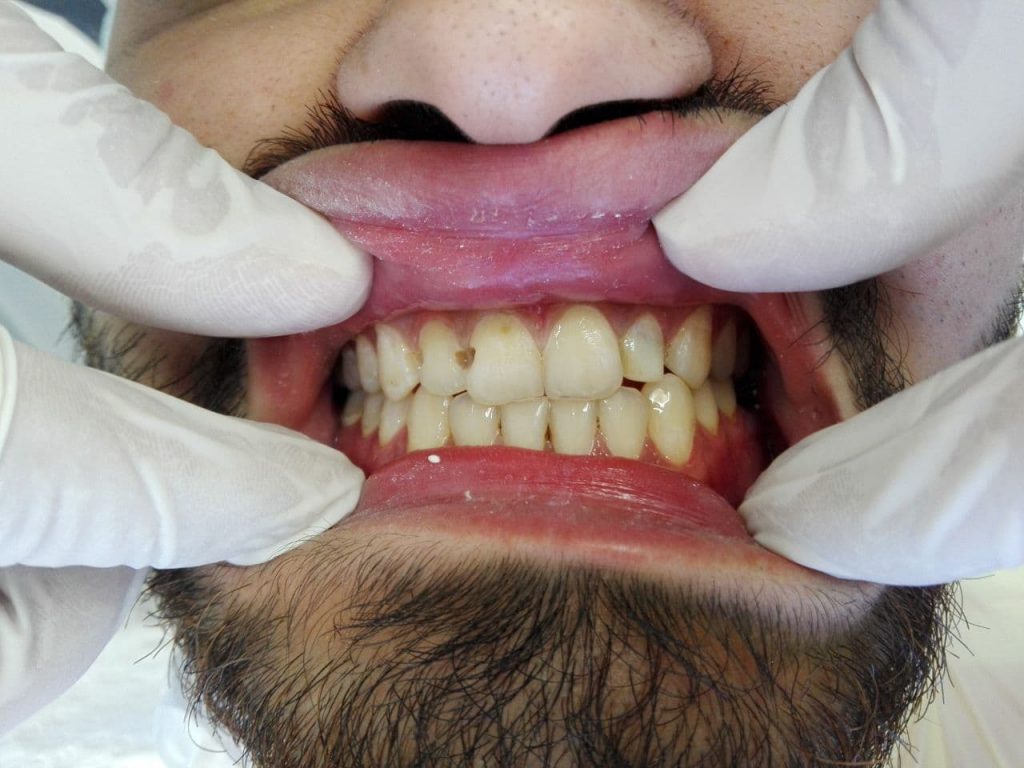 قبل از انجام لمینت دندان