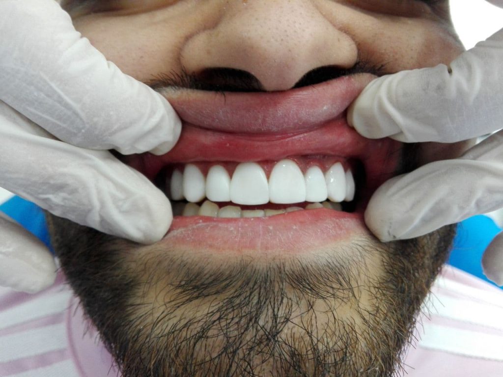 بعد از انجام لمینت دندان