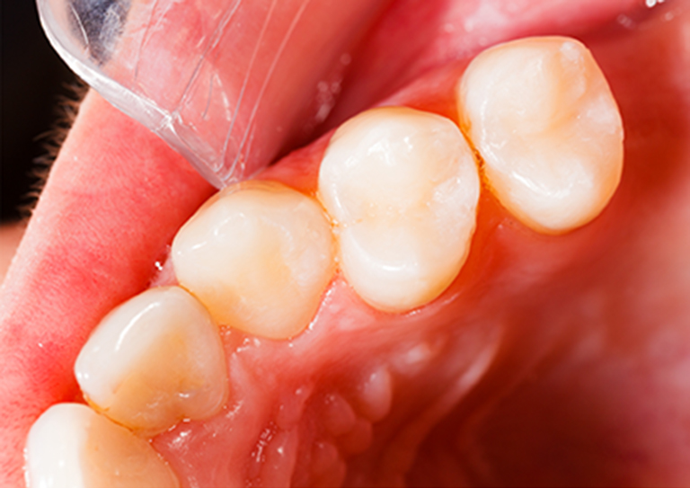 درمان عصب کشی دندان