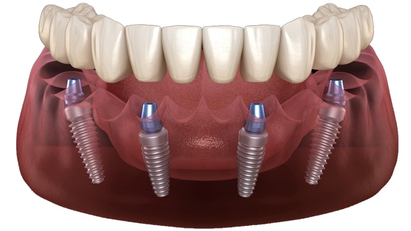 جایگزینی دندانهای از دست رفته به روش دندان مصنوعی 4 ایمپلنتی 