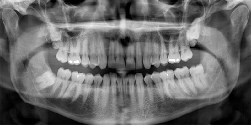 رادیولوژی دندان