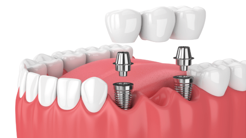 بریج ثابت بر پایه ایمپلنت جزء روشهای جایگزینی دندان از دست رفته