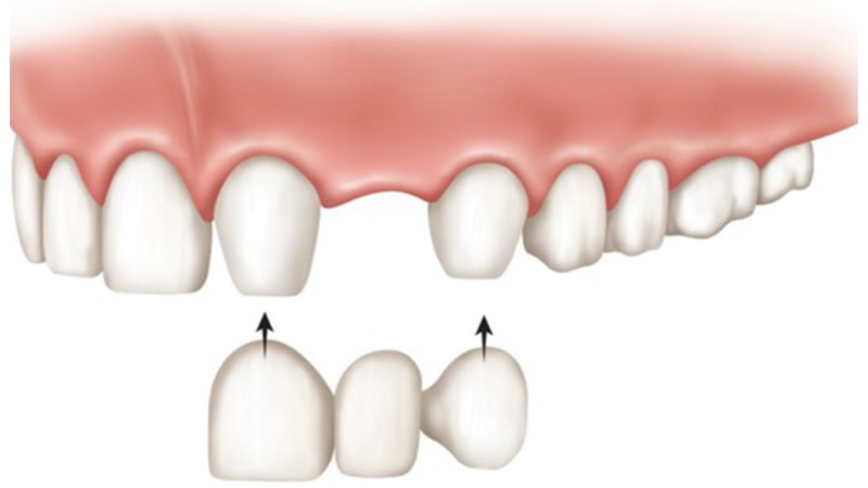 یکی از روشهای جایگزینی دندان از دست رفته، بریج دندان است