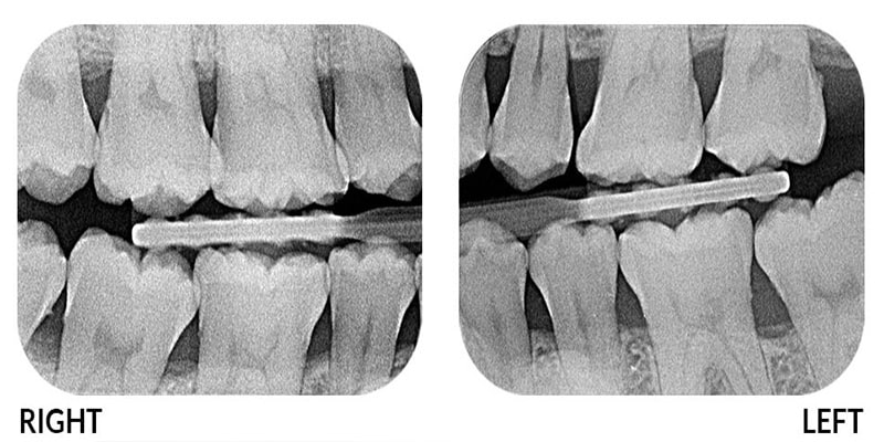 عکس ایکس ری دندان