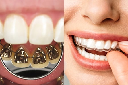 ارتودنسی شفاف