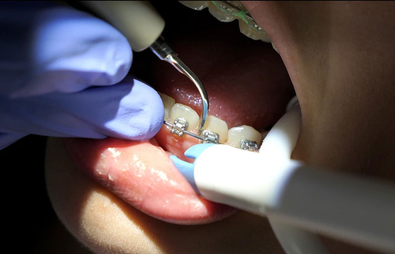 جرمگیری دندان ارتودنسی شده