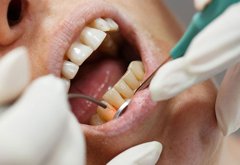 جرمگیری دندان با لیزر آیا امکان پذیر است