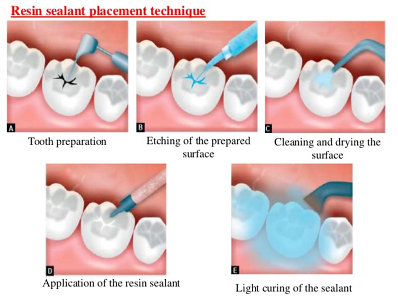 مراحل پر کردن دندان 