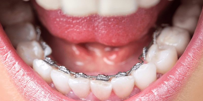 براکت پشت دندانی