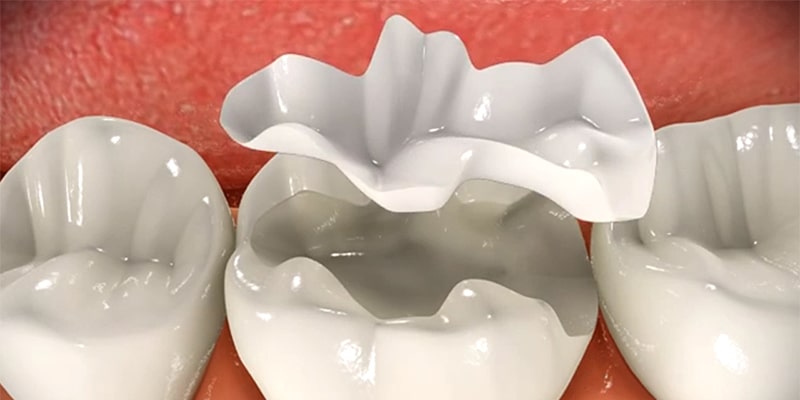 سرامیک جزء مواد پر کردنی دندان