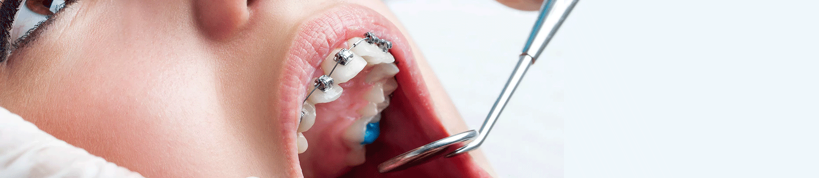 بریس ارتودنسی دندان