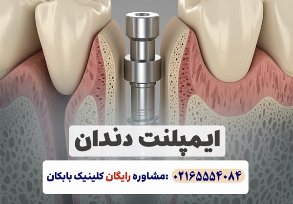 جراحی ایمپلنت دندان