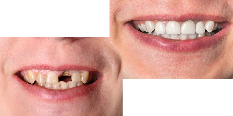 کاربرد ها ترمیم دندان