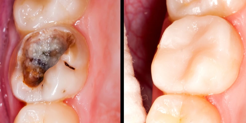 مزایای ترمیم دندان