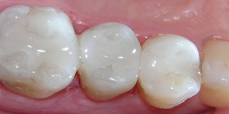 پر کردن دندان با مواد یونومر شیشه