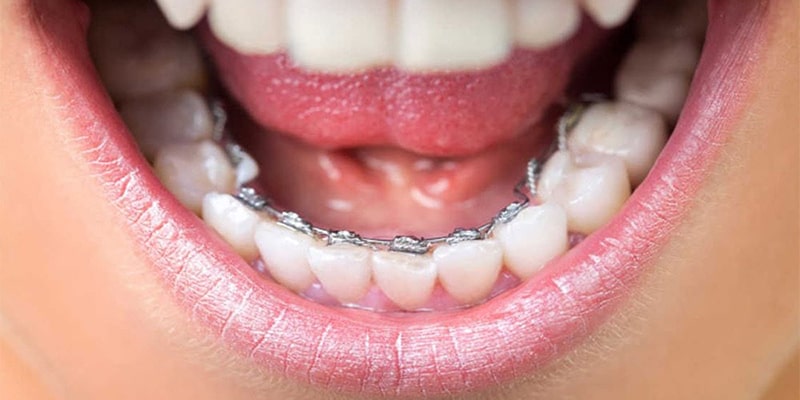 معایب و مزایای براکت پشت دندانی در ارتودنسی ثابت