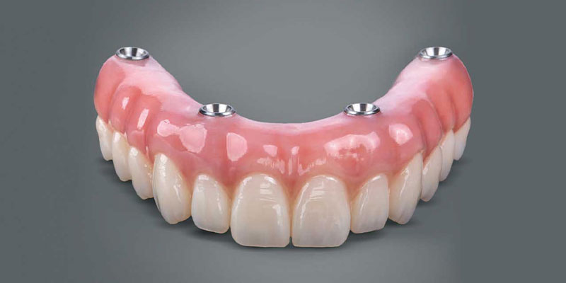 معایب و مزایای دندان مصنوعی چهار ایمپلنتی