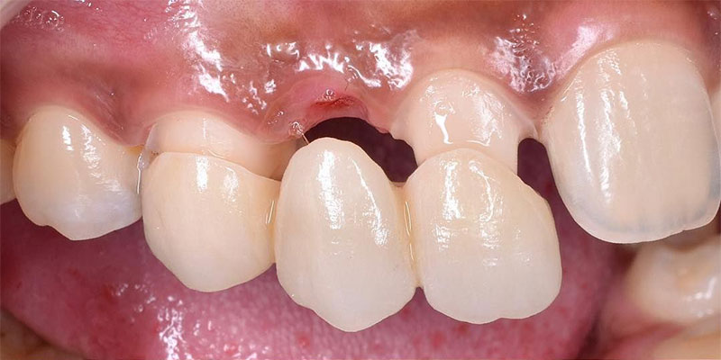 معایب و مزایای بریج دندان