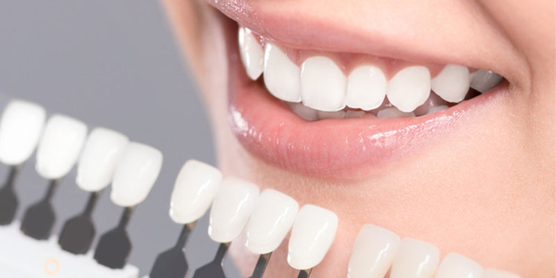 انواع درمان های زیبایی دندان
