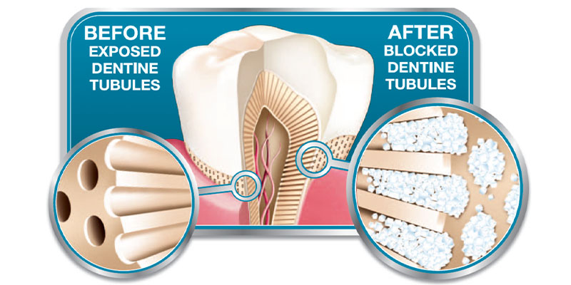 تونلهای موجود در لایه عاج دندان و ایجاد حساسیت دندان