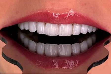 کامپوزیت دندان چیست