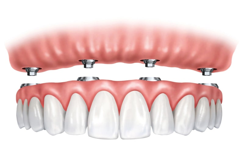 دندن مصنوعی چیست