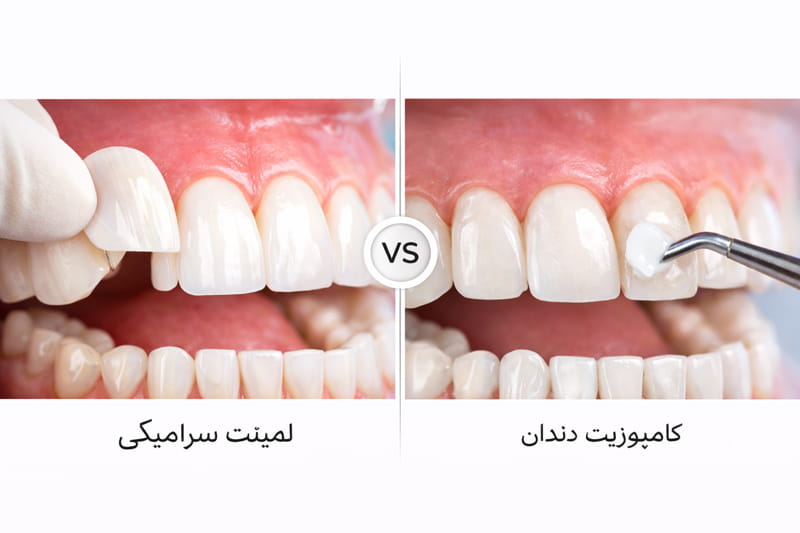 فرق کامپوزیت و لمینت دندان