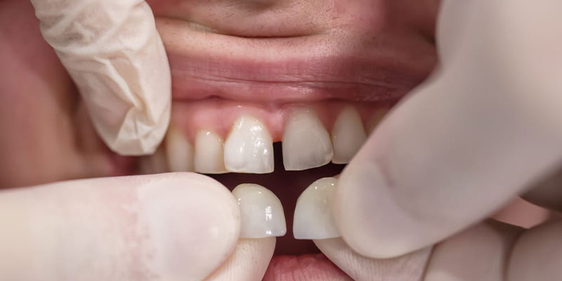 انواع لمینت دندان و تفاوت آن با کامپوزیت