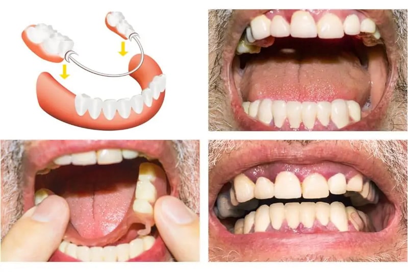 دندان مصنوعی چیست