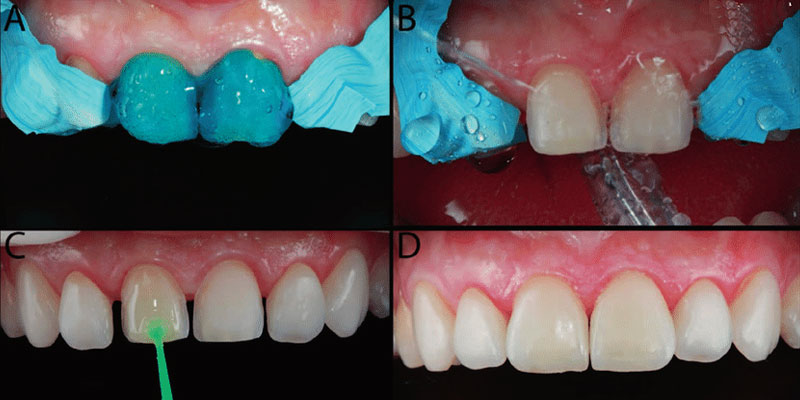 انواع کامپوزیت دندان و تفاوت آن با لمینت