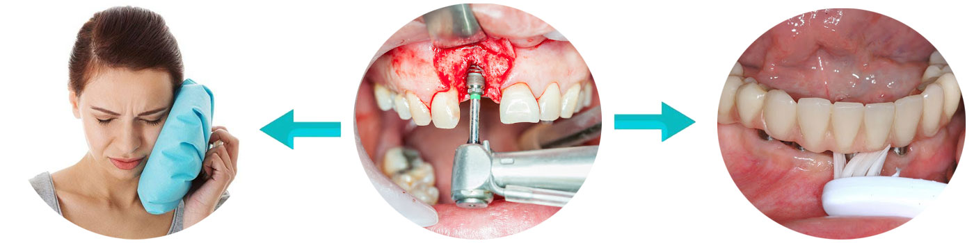 مراقبت پس از کاشت ایمپلنت دندان