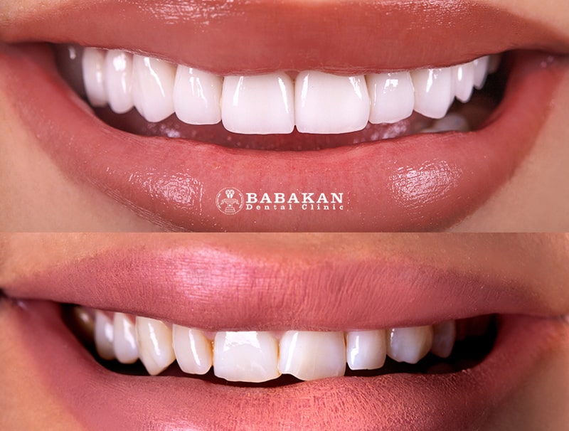 بهترین نوع کامپوزیت دندان