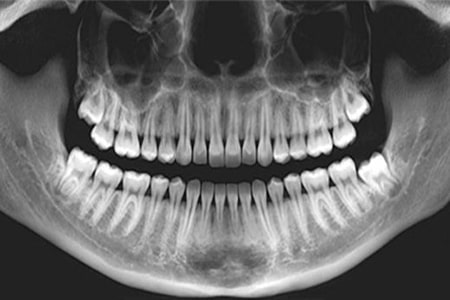 عکس او پی جی (opg) دندان