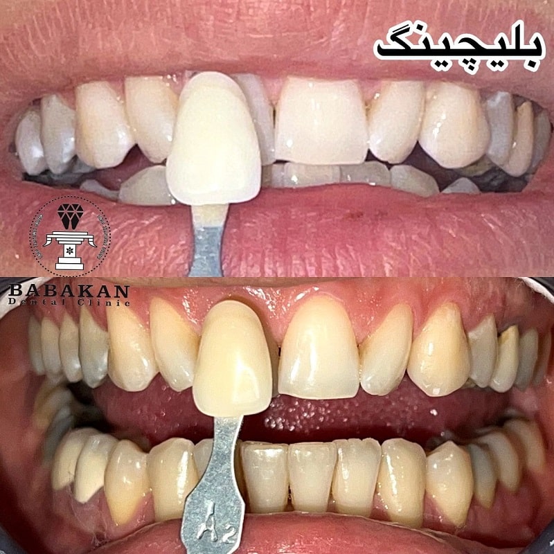 نمونه درمان بلیچینگ دندان