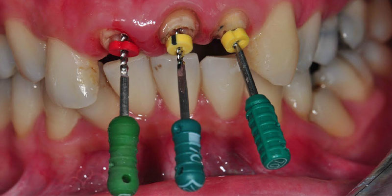 عصب کشی دندان یا درمان ریشه