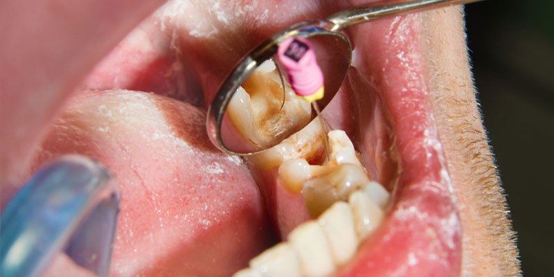 عصب کشی دندان در بارداری
