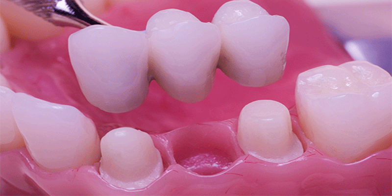 کاشت دندان به روش بریج
