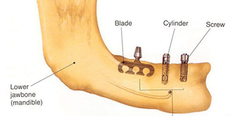ایمپلنتهای Endosteal