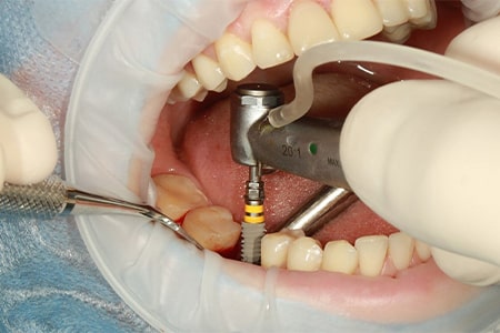 روش های کاشت دندان