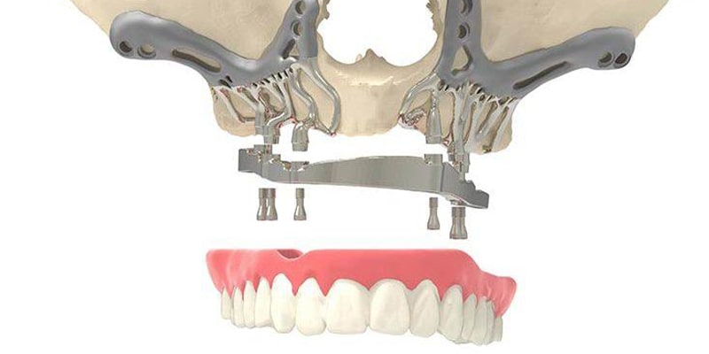 ایمپلنت Subperiosteal
