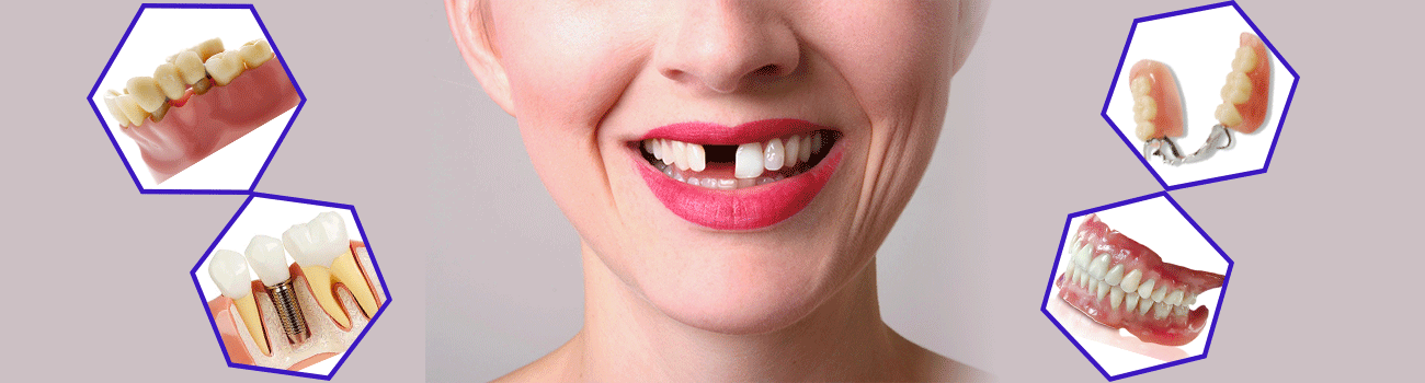 روش های کاشت دندان