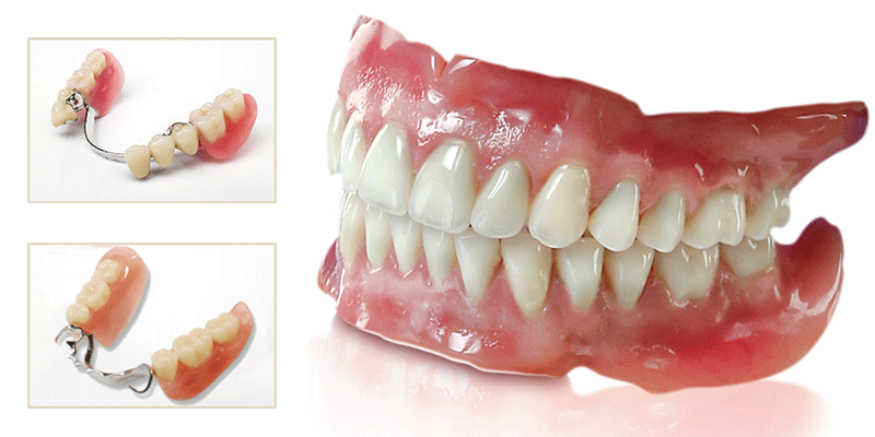 روش کاشت دندان به کمک دندان‌ های مصنوعی
