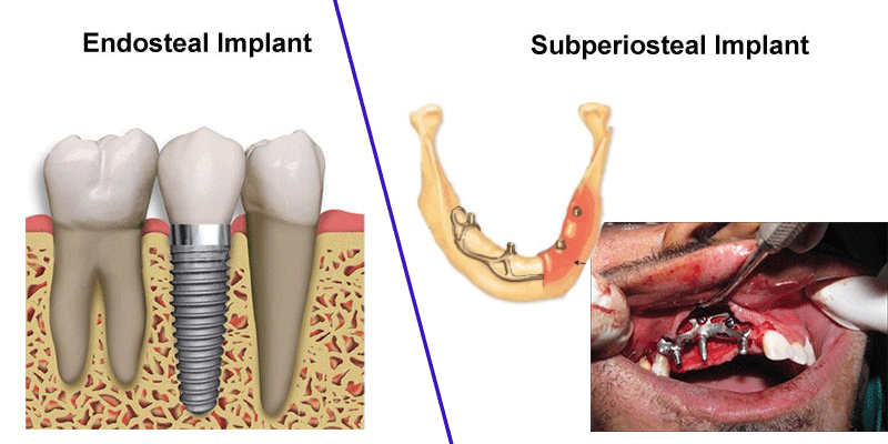 انواع کاشت دندان به روش ایمپلنت