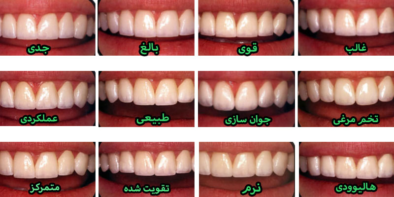 انواع مدلهای دندانها برای لمینت دندان