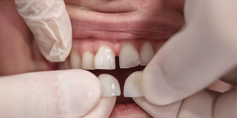 چگونگی لمینت دندان خرگوشی و کج