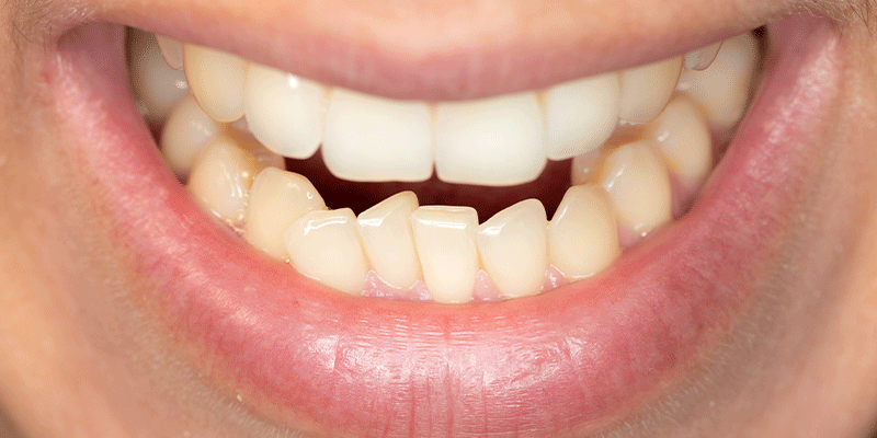 چه عواملی باعث کجی و نامرتبی دندان ها می شود